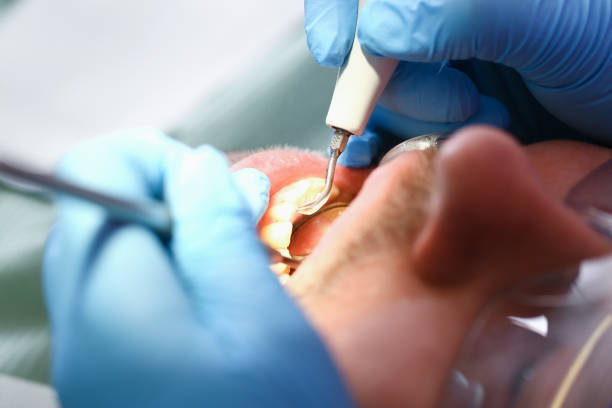 Best Emergency Tooth Extraction in Murrells Inlet, SC
